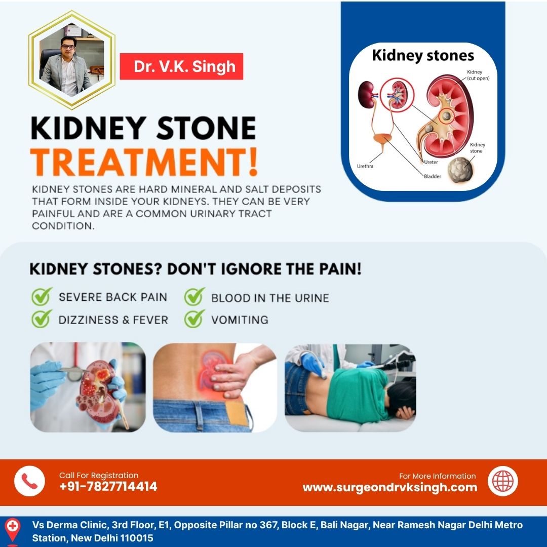 Kidney Stone Treatment by Dr. V.K. Singh